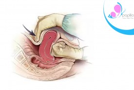 Atonia Uteri (The uterus does not contract)
